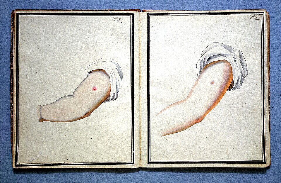 Historical medical watercolor comparing smallpox and cowpox inoculation marks